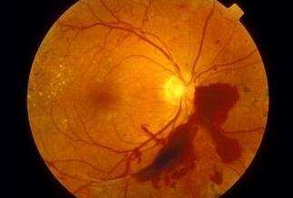 糖尿病视网膜病变.jpg 糖尿病视网膜病变.jpg