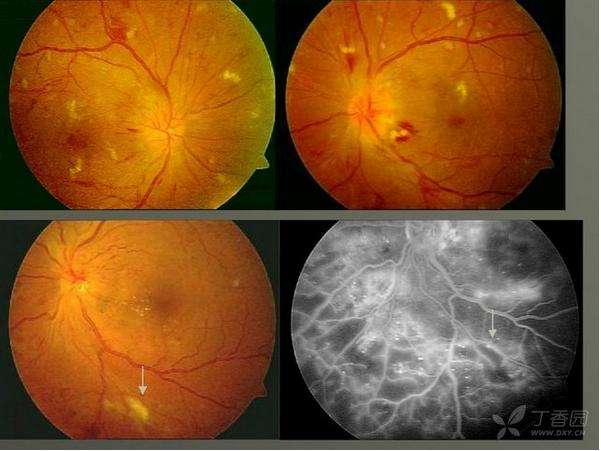 糖尿病视网膜病 糖尿病视网膜病