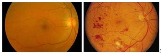 70%的糖尿病患者会出现全身小血管和微血管病变,影响全身组织的供养,进而导致一系列严重的并发症。糖尿病也可以引起一系列眼部疾病,包括白内障、青光眼、眼球运动障碍等,其中较为严重的就是糖尿病视网膜病变,它可以严重影响视力的一种疾病,已经成为四大主要致盲疾病之一。糖尿病引起的失明者比一般人高10到25倍。据有关资料统计,糖尿病患病时间越长,患者出现视网膜病变的比率越大。.jpg 70%的糖尿病患者会出现全身小血管和微血管病变,影响全身组织的供养,进而导致一系列严重的并发症。糖尿病也可以引起一系列眼部疾病,包括白内障、青光眼、眼球运动障碍等,其中较为严重的就是糖尿病视网膜病变,它可以严重影响视力的一种疾病,已经成为四大主要致盲疾病之一。糖尿病引起的失明者比一般人高10到25倍。据有关资料统计,糖尿病患病时间越长,患者出现视网膜病变的比率越大。.jpg
