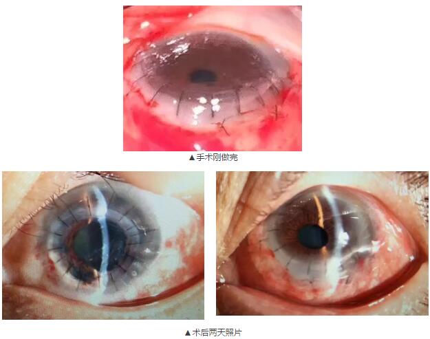 即便天气如此恶劣,合肥名人眼科医院的所有医护人员依然兢兢业业的守护在自己的岗位上。其中有两位患者分别来自安徽的蒙城和涡阳,一 角膜愈着性白斑,致虹膜前后黏连,视力仅有手动。另一 角膜严重边缘变性致穿孔,急需通过角膜移植手术保住眼球。.jpg 即便天气如此恶劣,合肥名人眼科医院的所有医护人员依然兢兢业业的守护在自己的岗位上。其中有两位患者分别来自安徽的蒙城和涡阳,一 角膜愈着性白斑,致虹膜前后黏连,视力仅有手动。另一 角膜严重边缘变性致穿孔,急需通过角膜移植手术保住眼球。.jpg