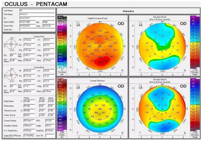 圆锥角膜是一种角膜扩张性疾病,患病后角膜中央或偏中央区域会发生局部变薄向外扩张,导致散光,并随着病情进展逐渐出现视力下降、 不良、视物扭曲变形、虹视等,极大影响生活,严重者可致盲。.jpg 圆锥角膜是一种角膜扩张性疾病,患病后角膜中央或偏中央区域会发生局部变薄向外扩张,导致散光,并随着病情进展逐渐出现视力下降、 不良、视物扭曲变形、虹视等,极大影响生活,严重者可致盲。.jpg