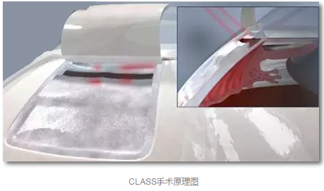 成都易游体育已经开展的青光眼手术有:引流阀 (钉)植入手术(2015年以来已200多 ),360°Schlemm's管切开术,激光CO2 辅助巩膜深层切除术,小梁切除术青(光眼)白(内障)联合手术。还有虹膜周切术、前房成形术、 虹膜复位术,睫状体冷冻术,小梁切开术和前房穿刺术等4.png 成都易游体育已经开展的青光眼手术有:引流阀 (钉)植入手术(2015年以来已200多 ),360°Schlemm's管切开术,激光CO2 辅助巩膜深层切除术,小梁切除术青(光眼)白(内障)联合手术。还有虹膜周切术、前房成形术、 虹膜复位术,睫状体冷冻术,小梁切开术和前房穿刺术等4.png