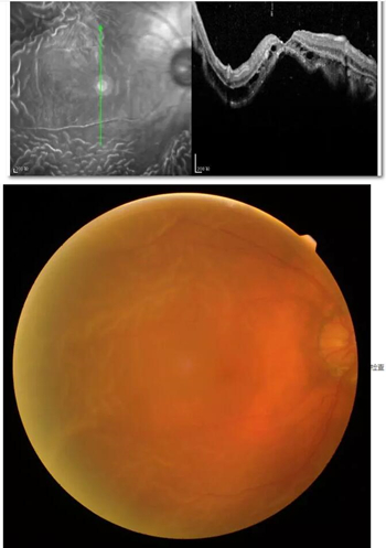 李老太在毫无征兆的情况下右眼视力下降至看不见东西。李老太家人带其至县医院就诊。医生诊断为视网膜脱离,需做玻切手术医治,而玻切手术需要动手术2次。怕疼的李老太一听就犯怵了:开刀,疼。 终,李老太的家人在多方打听后决定带李老太至宜昌易游体育找许大玲院长医治1_副本.jpg 李老太在毫无征兆的情况下右眼视力下降至看不见东西。李老太家人带其至县医院就诊。医生诊断为视网膜脱离,需做玻切手术医治,而玻切手术需要动手术2次。怕疼的李老太一听就犯怵了:开刀,疼。 终,李老太的家人在多方打听后决定带李老太至宜昌易游体育找许大玲院长医治1_副本.jpg
