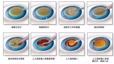 如今福州眼科医院白内障专科能为患者提供规格齐全的功能性人工晶状体,功能性人工晶体不但能告别白内障,而且能 老花、视光、散光等问题,三焦点晶体更可提供近、中、远全程视力,改进夜间视力等。同时还将为 个患者量“眼”定制、满足不同用眼需求4.jpg
