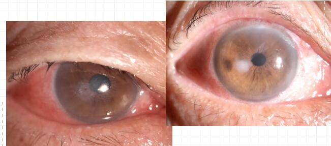 重庆老头角膜穿刺后在易游体育修补并进行白内障手术.jpg 重庆老头角膜穿刺后在易游体育修补并进行白内障手术.jpg