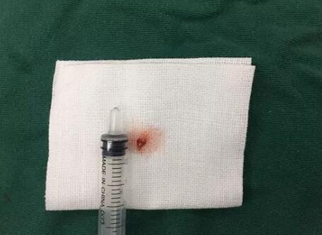 四川丹巴15岁男孩患结膜血管瘤,在成都易游体育顺利手术3.jpg 四川丹巴15岁男孩患结膜血管瘤,在成都易游体育顺利手术3.jpg