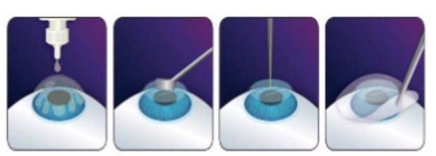 近视无法根治?但你可以这样做?易游体育“有爱就有希望”近视手术火热进行中1.png 近视无法根治?但你可以这样做?易游体育“有爱就有希望”近视手术火热进行中1.png