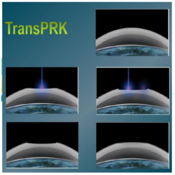 近视无法根治?但你可以这样做?易游体育“有爱就有希望”近视手术火热进行中3.png 近视无法根治?但你可以这样做?易游体育“有爱就有希望”近视手术火热进行中3.png