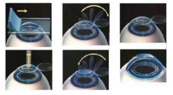 近视无法根治?但你可以这样做?易游体育“有爱就有希望”近视手术火热进行中4.png 近视无法根治?但你可以这样做?易游体育“有爱就有希望”近视手术火热进行中4.png