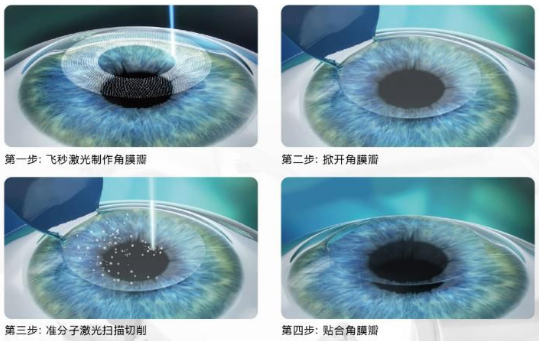 近视无法根治?但你可以这样做?易游体育“有爱就有希望”近视手术火热进行中5.png 近视无法根治?但你可以这样做?易游体育“有爱就有希望”近视手术火热进行中5.png