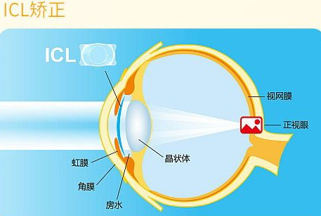 近视无法根治?但你可以这样做?易游体育“有爱就有希望”近视手术火热进行中8.png 近视无法根治?但你可以这样做?易游体育“有爱就有希望”近视手术火热进行中8.png
