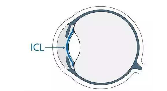 在杭州易游体育高度近视手术后,近视2550度配不到眼镜的四川大哥,看清了!4.png 在杭州易游体育高度近视手术后,近视2550度配不到眼镜的四川大哥,看清了!4.png