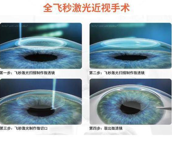 菏泽易游体育近视手术王2.png