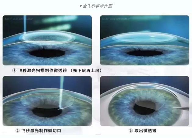 7月26日来深圳易游体育参与暑期摘镜季活动就可以有机会参与抽奖免单手术!2.png 7月26日来深圳易游体育参与暑期摘镜季活动就可以有机会参与抽奖免单手术!2.png