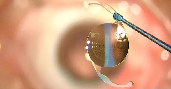 成都易游体育开展了医院首例白内障爱尔康三焦点人工晶体植入术.png 成都易游体育开展了医院首例白内障爱尔康三焦点人工晶体植入术.png