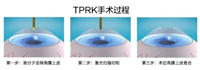 2021年征兵时间已定,参加征兵近视青年需尽快做近视手术3.png 2021年征兵时间已定,参加征兵近视青年需尽快做近视手术3.png